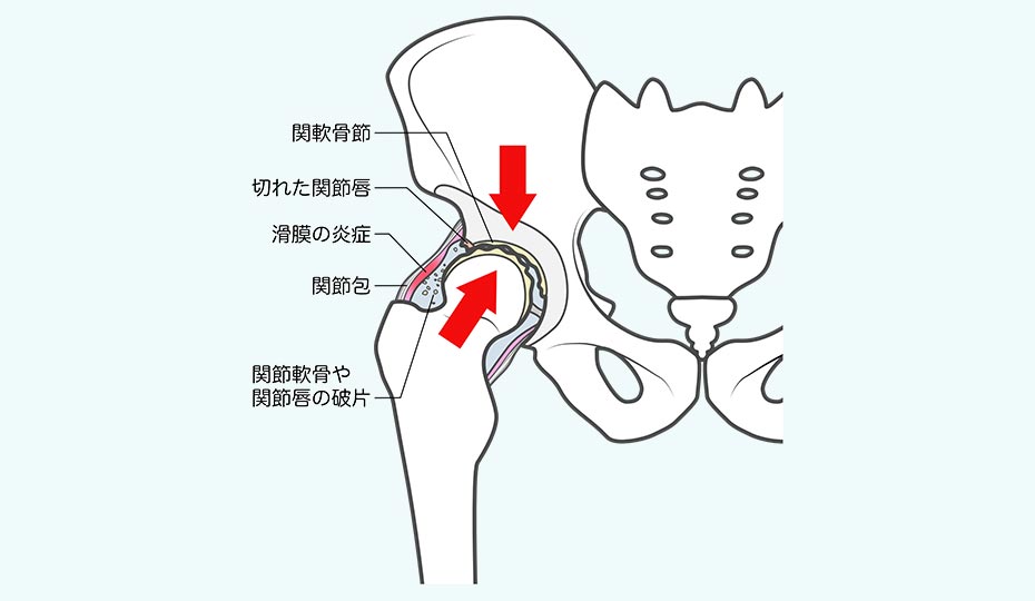 変形性股関節症　痛みの原因