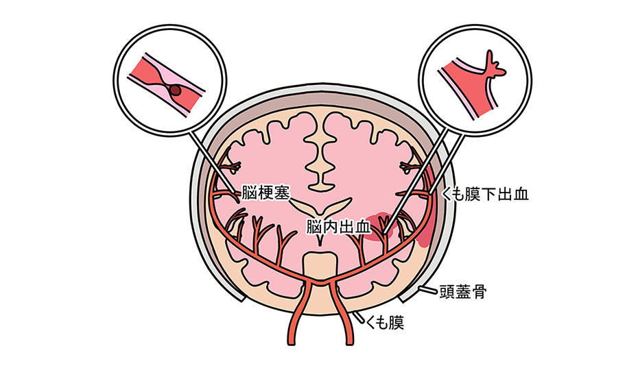 脳卒中の種類