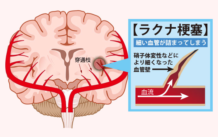 震えに対処する方法