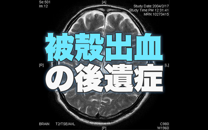 被殻出血と被殻出血に伴う後遺症