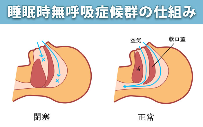 閉塞性睡眠時無呼吸症候群の原因