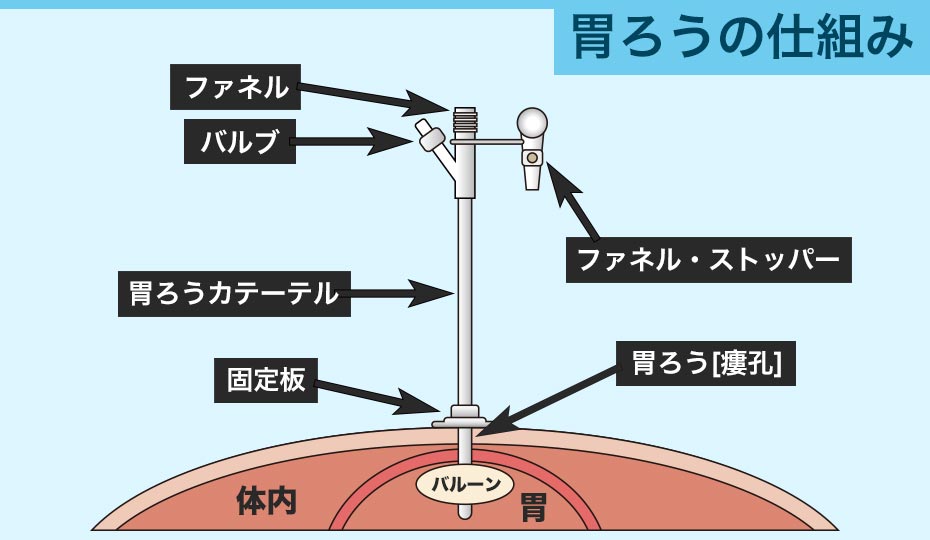 胃ろうについて