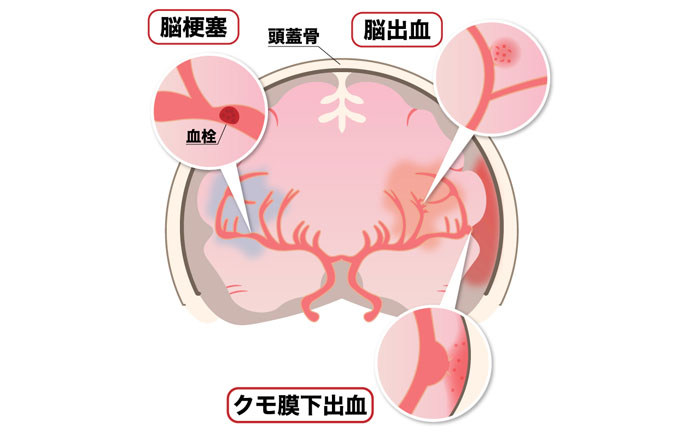  TIAとは何ですか?