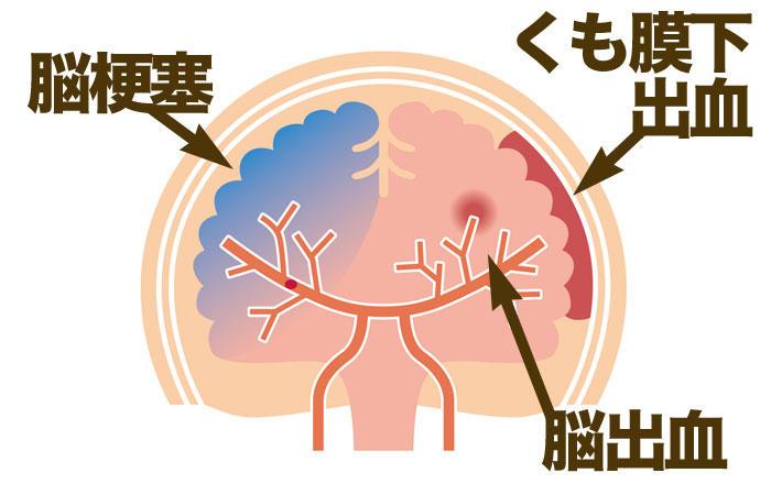 血栓性脳卒中の原因は何ですか?