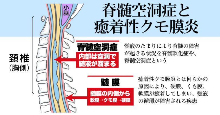 急性弛緩性脊髄炎の診断