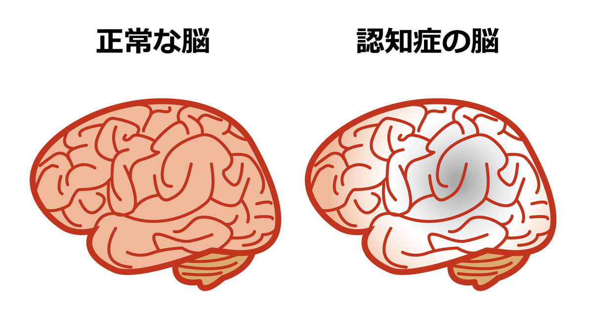 神経接続の喪失