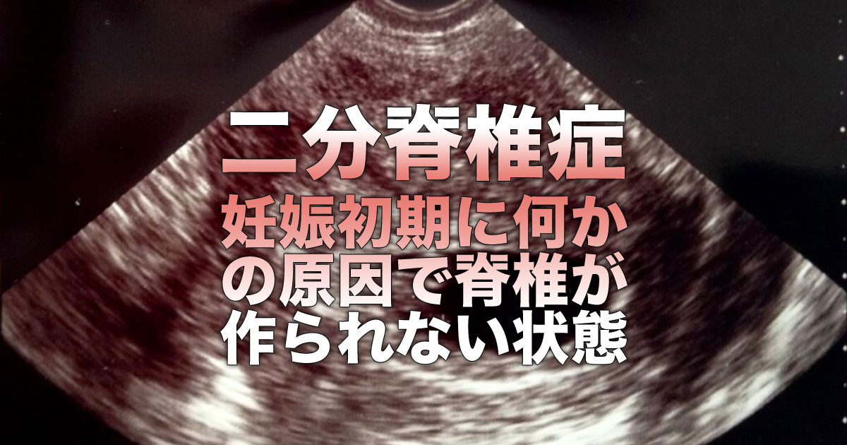 二分脊椎の原因