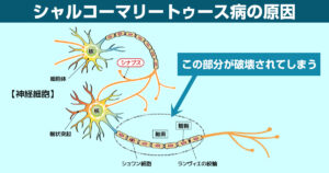 痙縮とは何ですか?