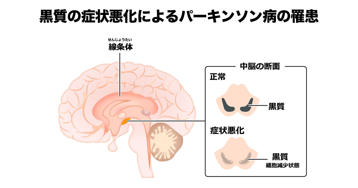 黒質の変性