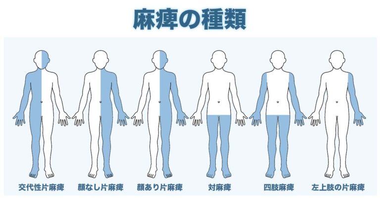 仮性球麻痺と球麻痺の人の見通しはどのように異なりますか?