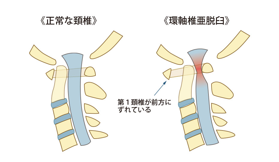環軸椎亜脱臼