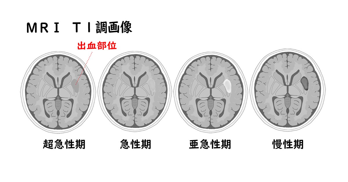 脳出血の経過MRI