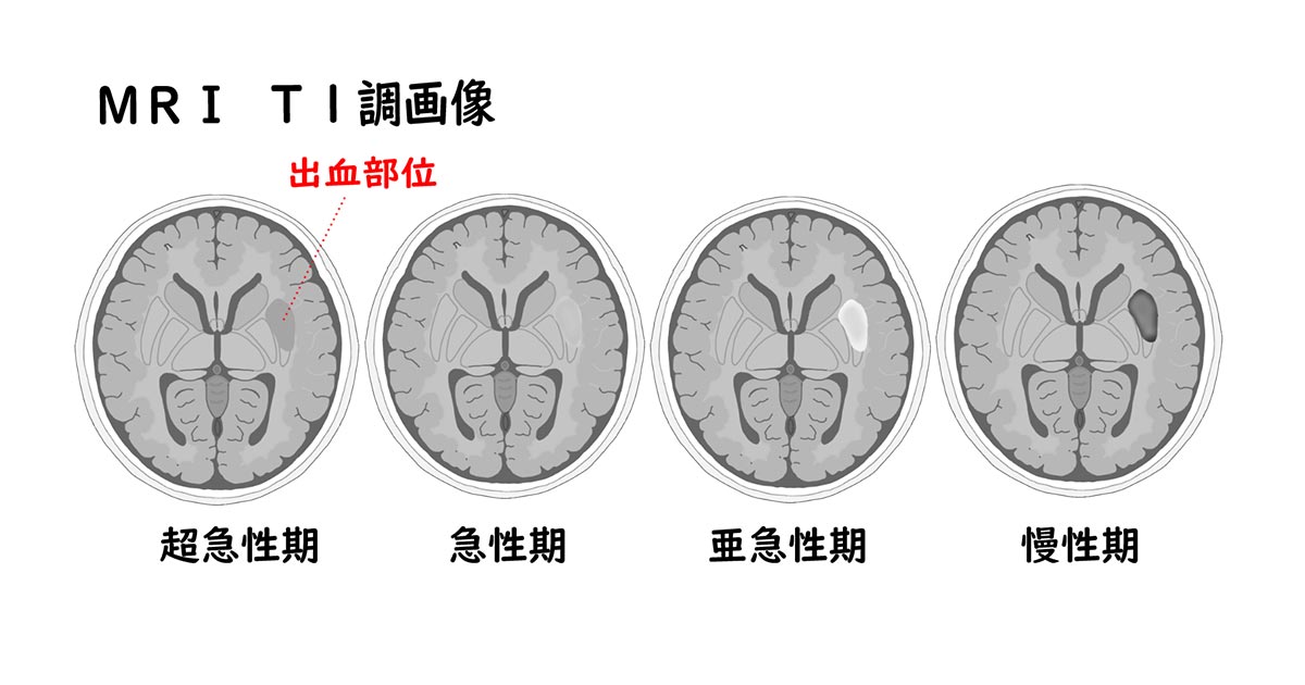 脳出血MRI