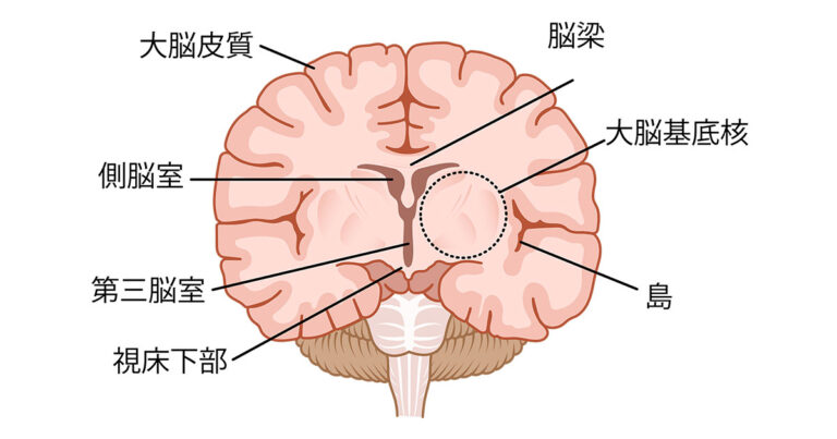 大脳皮質基底核変性症の治療とは? | 再生医療|脳梗塞・脊髄損傷の幹細胞治療|ニューロテックメディカル