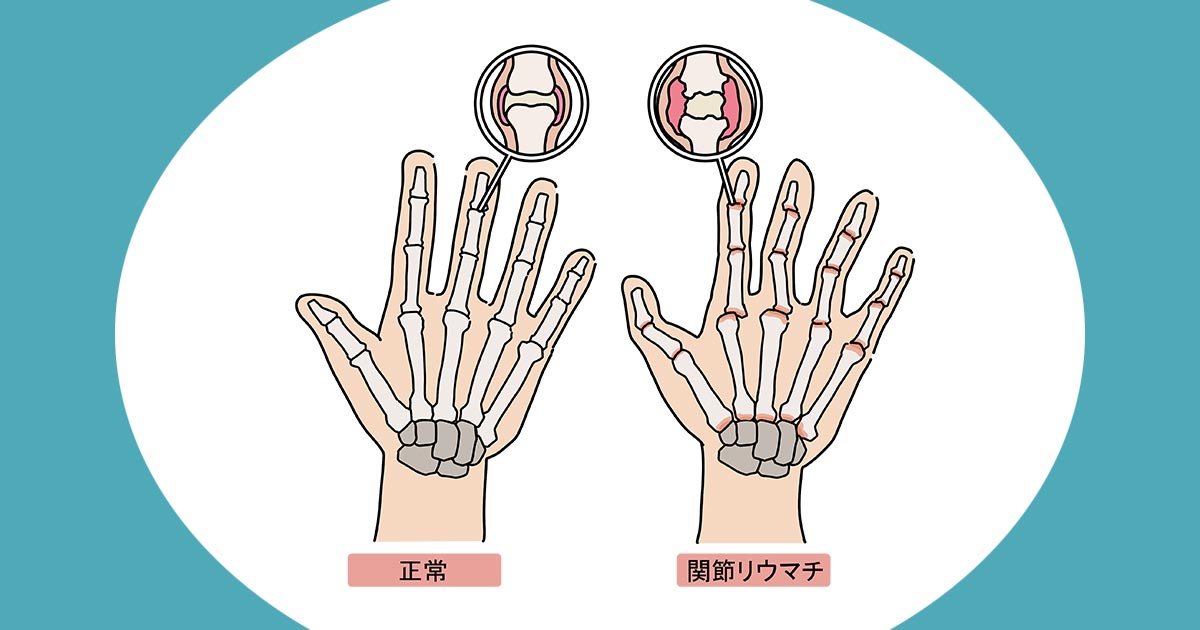 幹細胞療法とは何ですか?