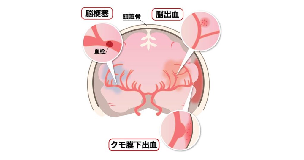 脳底静脈血栓症の合併症