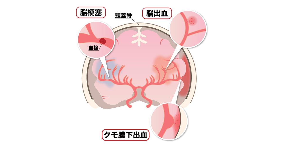 シリコン塞栓症とは何ですか？
