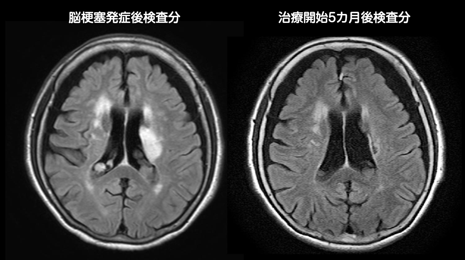 脳梗塞発症後の脳画像と治療開始5カ月後の脳画像との比較