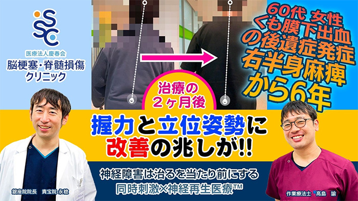 【再生医療+同時リハビリ】くも膜下出血の後遺症発症(右半身麻痺)から6年、握力と歩行に改善あり！【幹細胞点滴3回目投与の1カ月後検診】