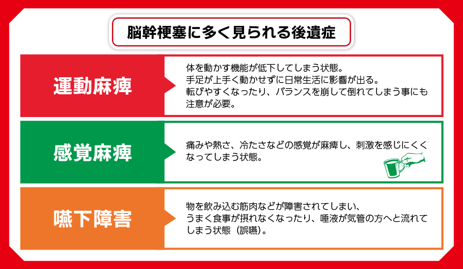 脳幹梗塞の多く見られる後遺症