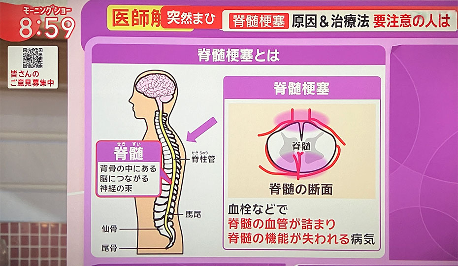 脊髄梗塞について