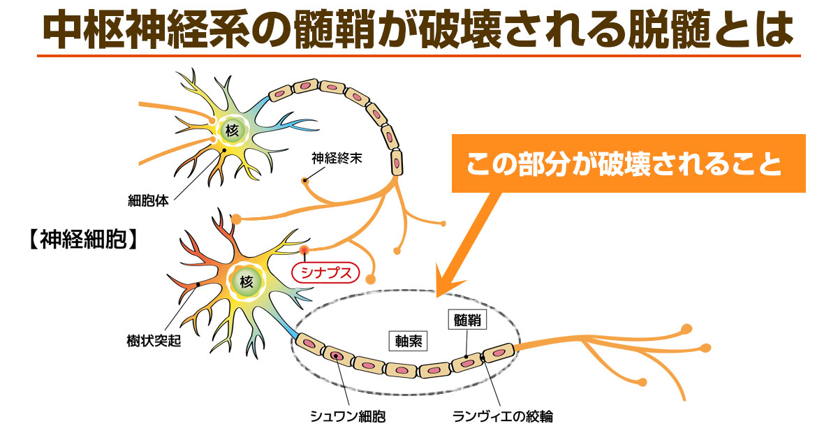 多発性硬化症の発症メカニズム