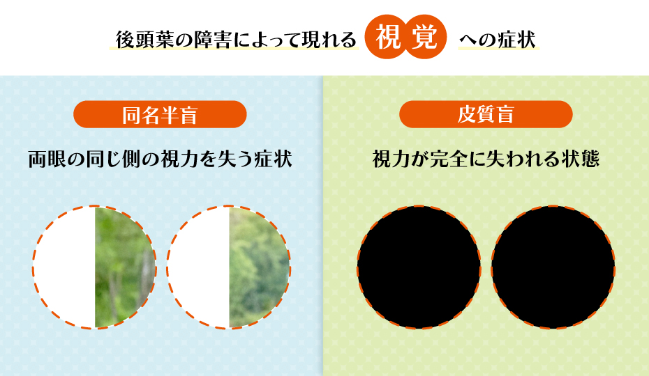後頭葉の障害によって現れる視覚への症状