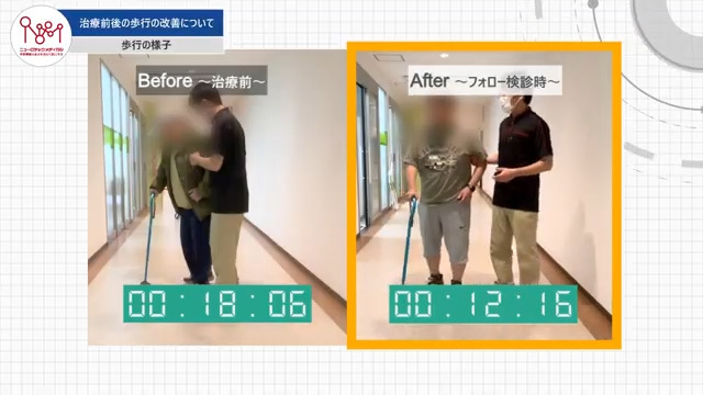 治療前後の歩行の改善について