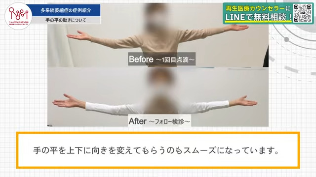 治療前と治療後の手の平の動きの比較