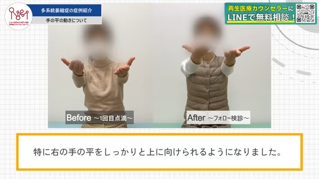 治療前と治療後の手の平の向きの比較