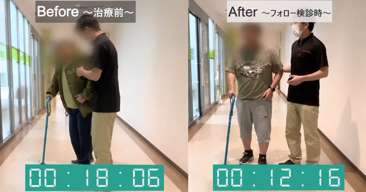治療前後の歩行の様子。歩行時間や歩数だけでなく、歩幅やバランスの変化も確認することが大切です。